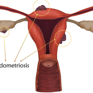 Uterus with endometriosis lesions