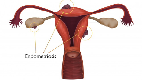 Uterus with endometriosis lesions